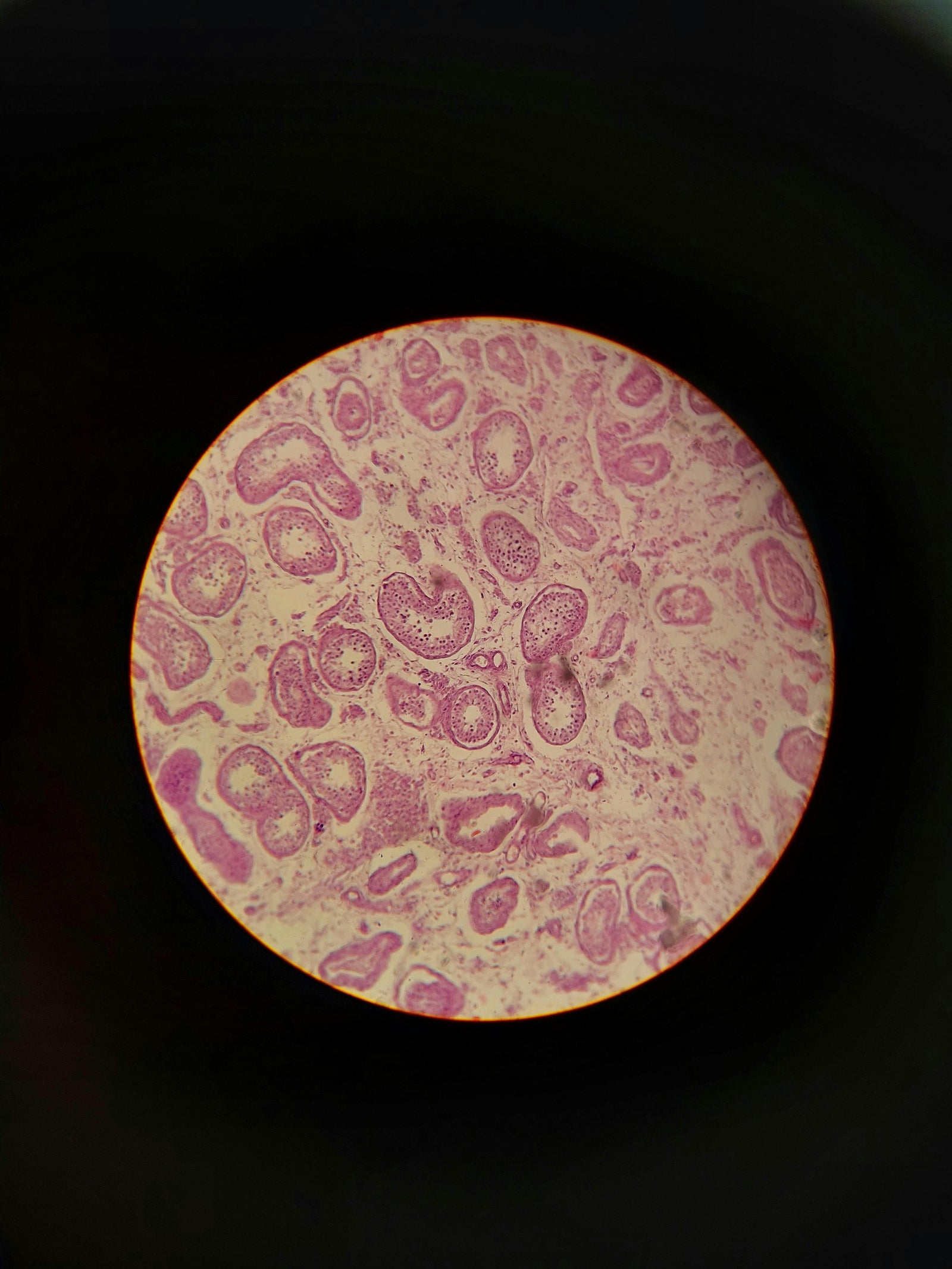 Selective Senolysis: Clearing “Zombie Cells” in Humans